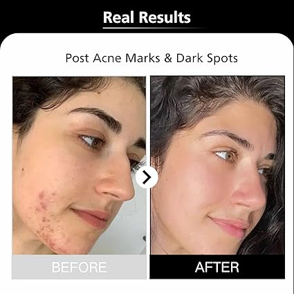 Alpha Arbutin Serum Dark Spots Removal for Face Lines & Wrinkles